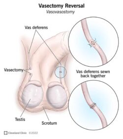 vasectomy reversal